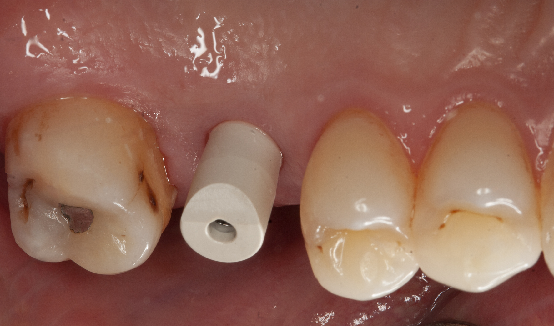 Eylos scan body in mouth palatal view
